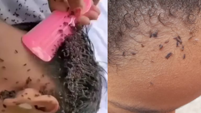 Menina de 4 anos tem CASO GRAVE de piolhos e seu estado de saúde é ASSUSTADOR: “Prestes à mor…Ver mais