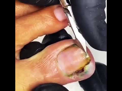 Olha o estado dessa unha, vejam o vídeo