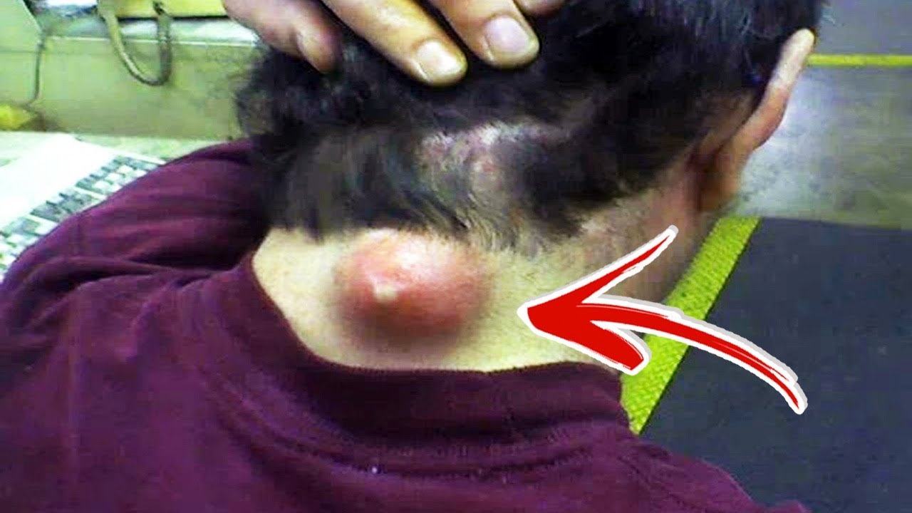 Olha o que saiu dessa espinha você não vai acreditar… VER MAIS