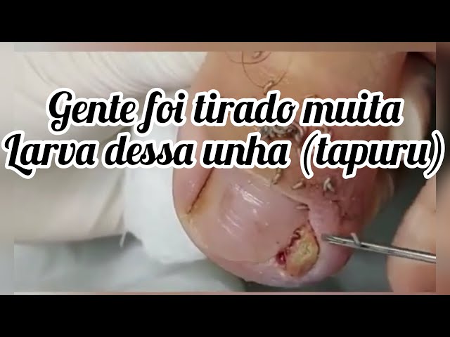 Tanto bicho na unha que saiu